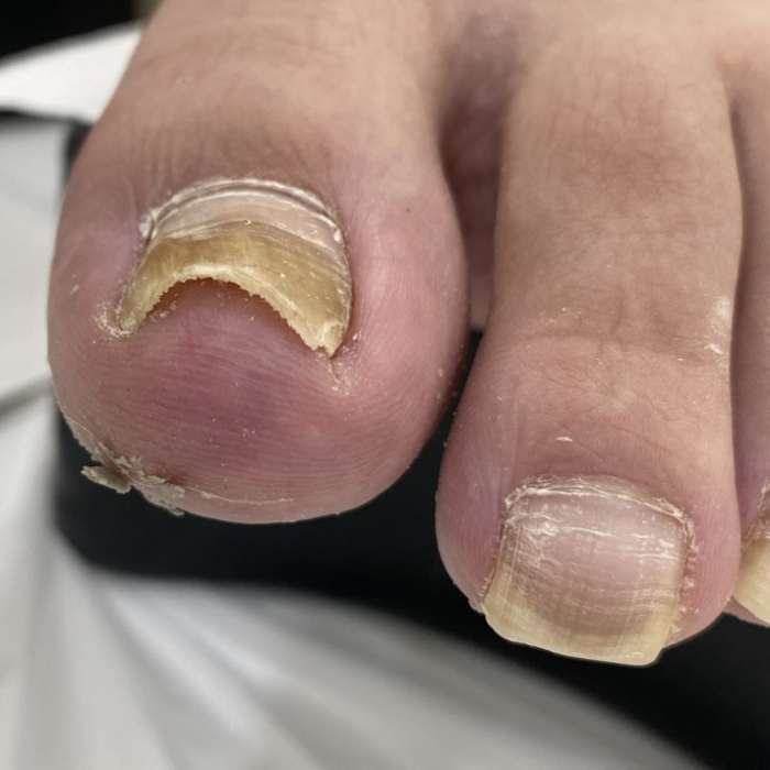 안쪽으로 휘어진 발톱과 교정 장치 적용 — 제공 자료의 치료 전 사진