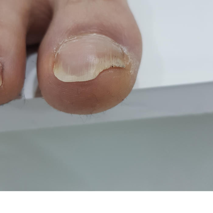 엄지발톱의 색과 표면 — 제공 자료의 치료 후 · 자료 표기 사진