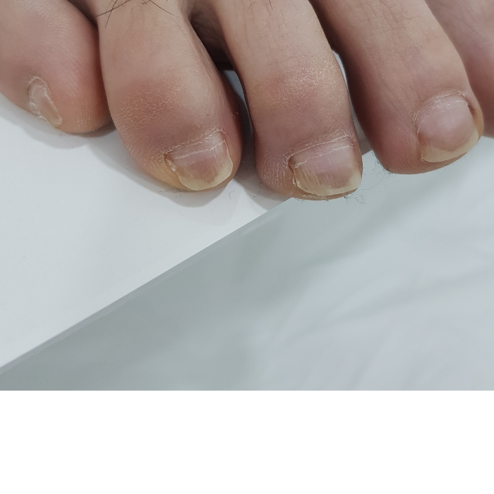 여러 발톱의 색과 표면 — 제공 자료의 치료 후 · 자료 표기 사진